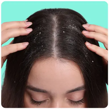 Dandruff