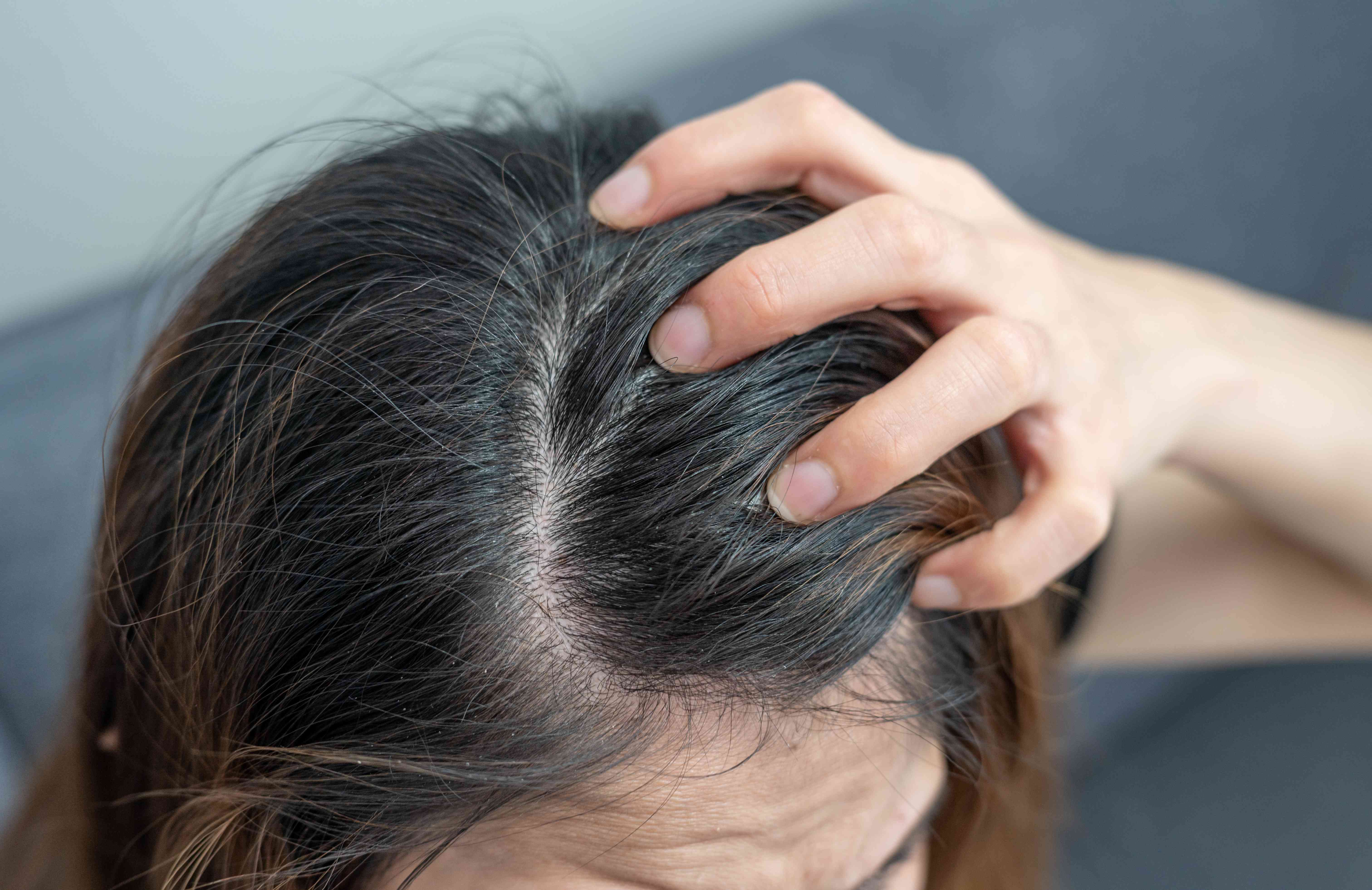 Itchy & Irritated Scalp
