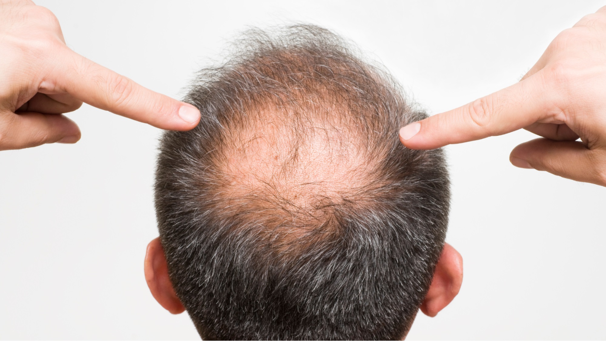 Bald Patches
